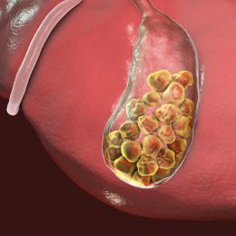 Камни в желчном: удалять пузырь или нет