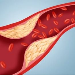 Атеросклероз туралы бізге мынаны білу міндетті