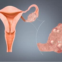 Поликистоз аналық без: неден қорқу керек және қалай күресу керек